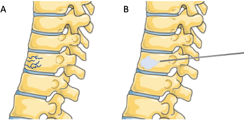 Cement, Balloons, and Race Cars: On the Evolution of Vertebroplasty â€“ SIR  RFS