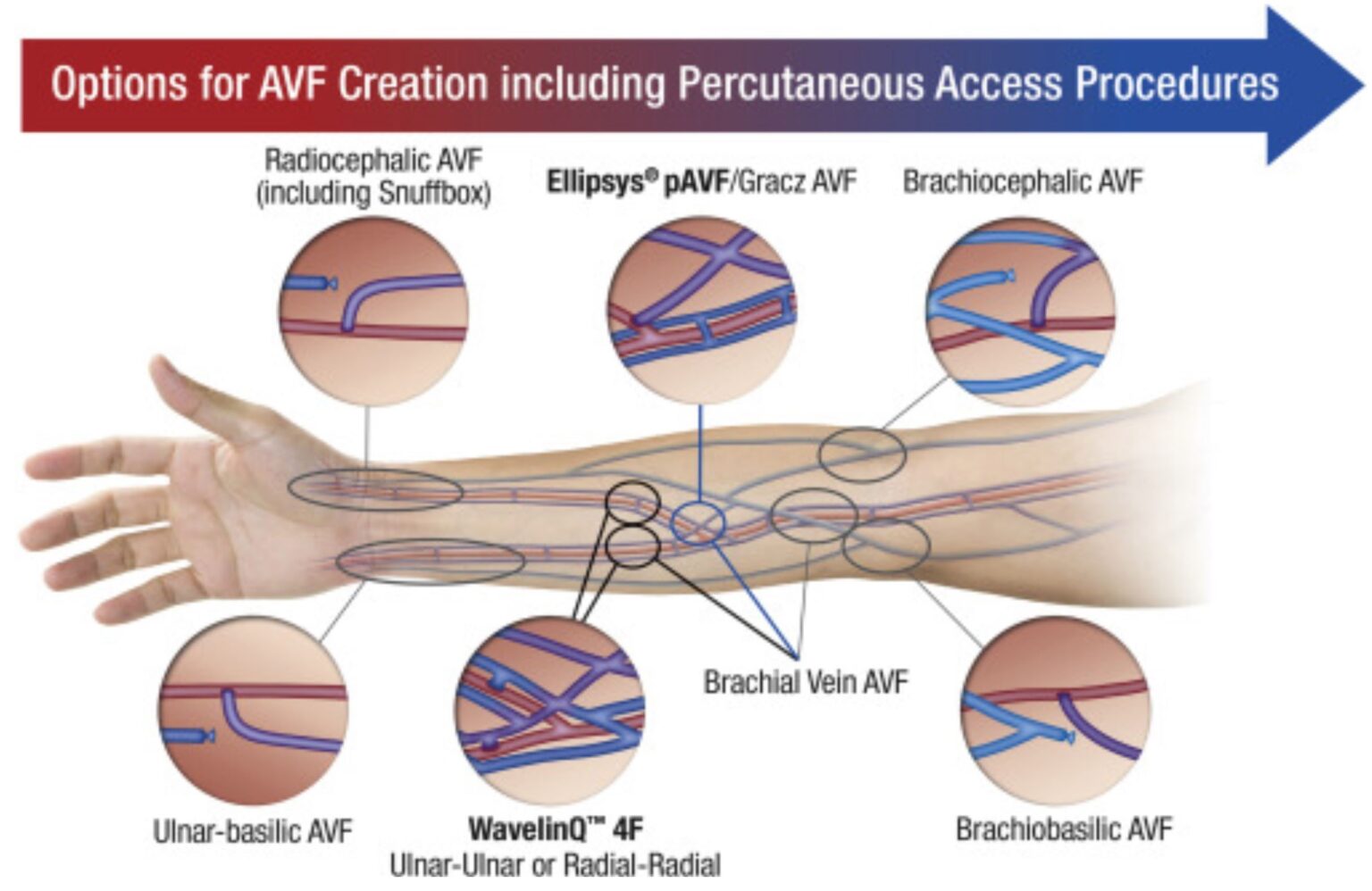 percutaneous-av-fistula-creation-using-ellipsys-and-wavelinq-sir-rfs